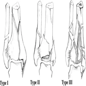 Pilon fracture